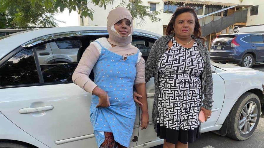 Mujer sufre graves quemaduras tras ataque con aceite caliente; agresor prófugo