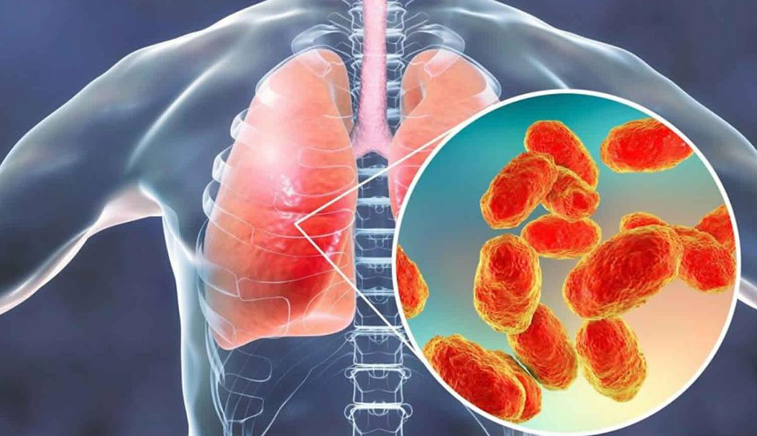 El Metapneumovirus Humano: Aumento de Casos en China y su Impacto Global